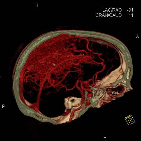 CT angiogram of the head 