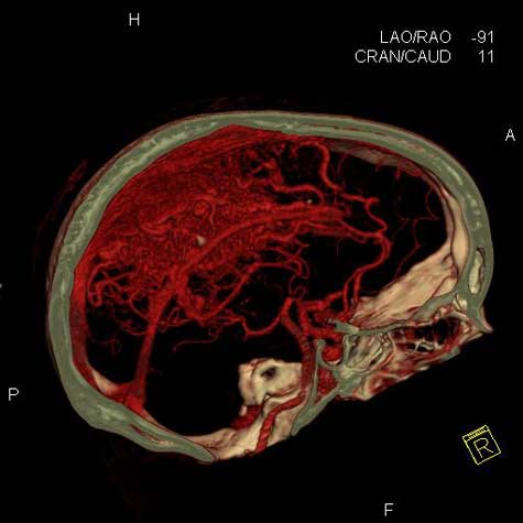 Angiografía por TC de la cabeza