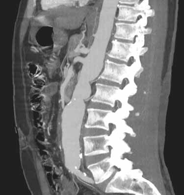 CT angiogram of the lumbar spine and abdominal aorta