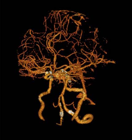 Imagen de angiografía por TC en 3-D de las arterias cerebrales