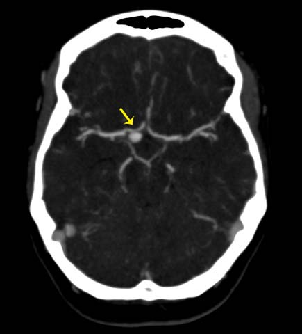 CT angiogram of the brain