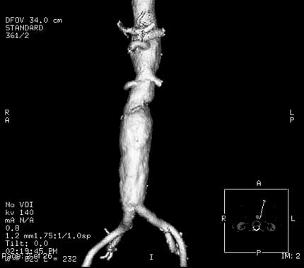 3-D CT view of the abdominal aorta