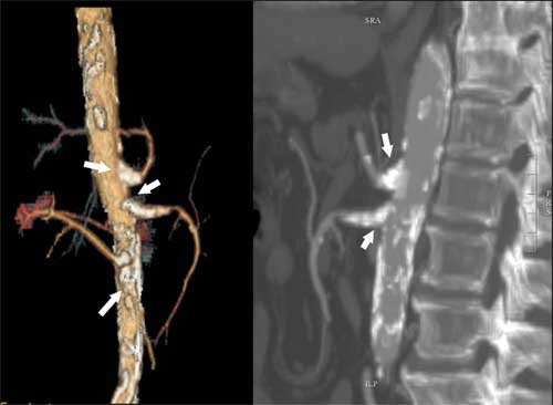3-D CT images of the abdominal aorta.