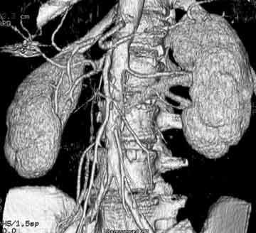 CTA image of abdominal aorta and arteries