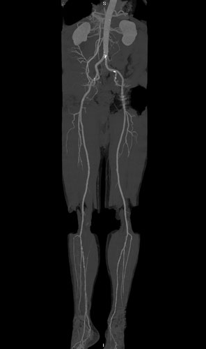 CT angiogram of the aorta and lower extremity arteries