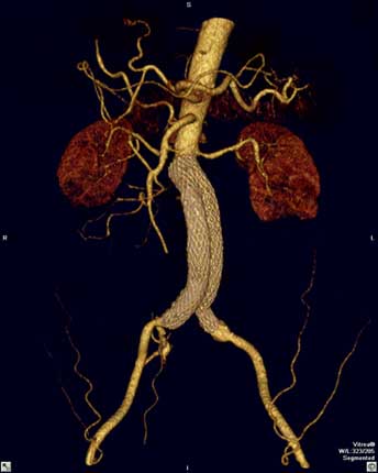 CT angiogram with a graft of the abdominal aorta