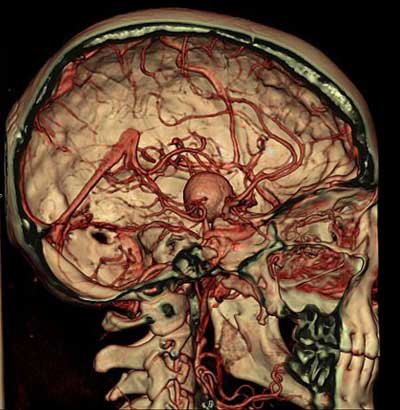  Angiografía por TC que muestra un aneursimo en la cabeza