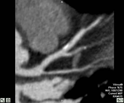 CT angiogram of the heart showing the LAD