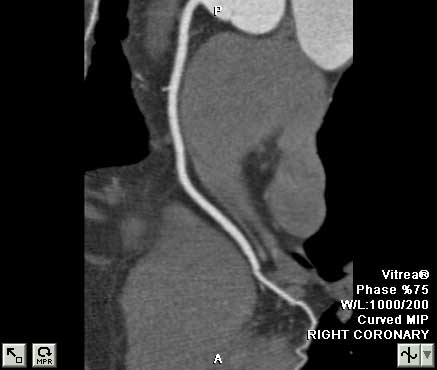 Angiografía por tomografía computarizada de una arteria coronaria
