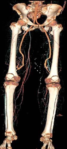 CT angiogram of lower extremities