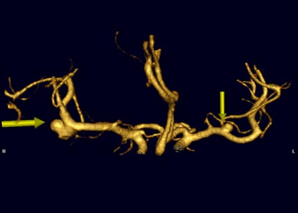 CTA showing aneurysmin cerebral arteries.