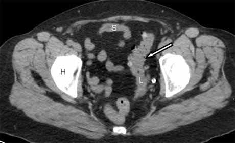 Imagen de TC que muestra diverticulosis.