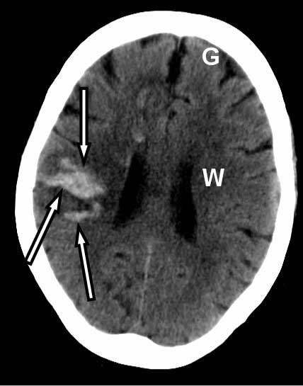 Imagen de tomografía computarizada que muestra sangrado dentro del cerebro por un derrame cerebral