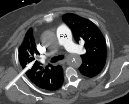 Una imagen de TC que muestra una embolia pulmonar (coágulo de sangre en el pulmón) dentro de una arteria pulmonar