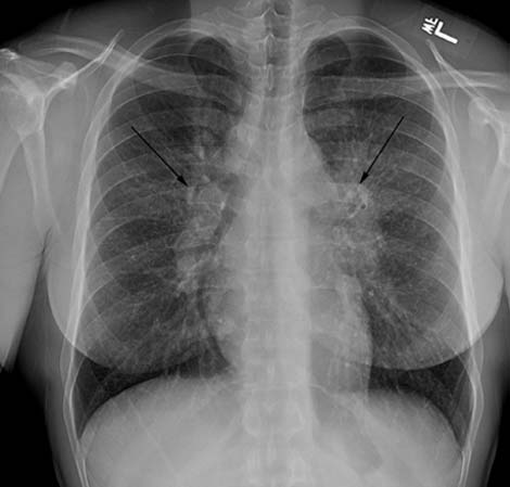 Imagen de rayos X mostrando una lifadenopatía perihiliar