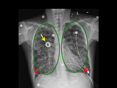 Chest x-ray showing cystic fibrosis 