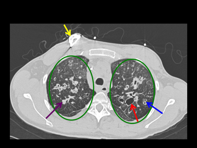 CT image of the upper chest showing a port catheter.