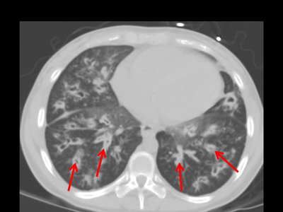  Imagen de TAC de los pulmones inferiores que muestra las vías respiratorias dilatadas y engrosadas.