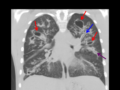 CT of the chest shows dilated airways.