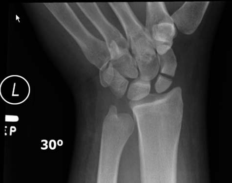 X-ray of a wrist with a fractured scaphoid bone
