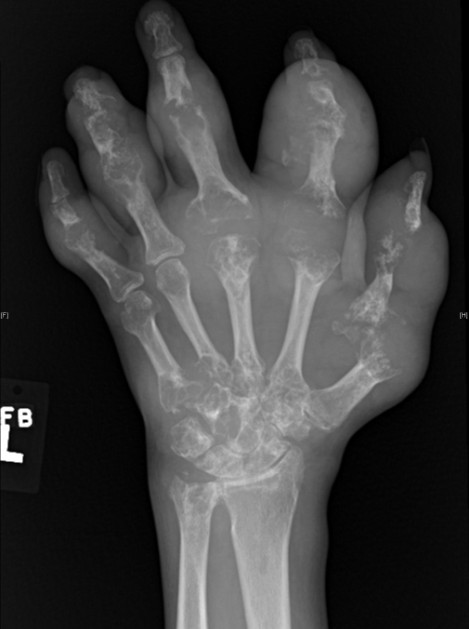 An x-ray of the hand in a patient with gout