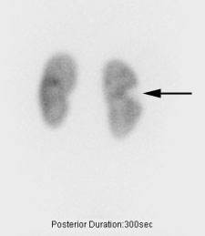 A nuclear medicine DMSA image of the kidneys in a young child