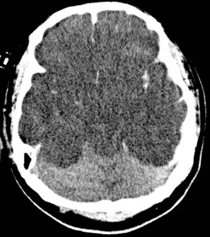  CT scan of the brain with diffuse anoxic (absence of oxygen) injury.