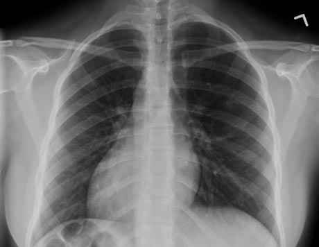 An x-ray of the chest demonstrating the heart