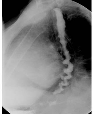 Un esofagograma mostrando un esófago 