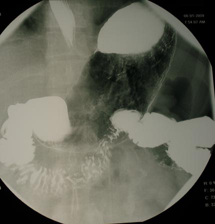 An x-ray image showing the stomach during an upper GI exam
