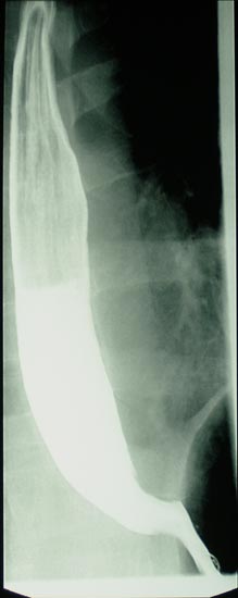 Una imagen de rayos X que muestra el esófago durante un examen GI superior