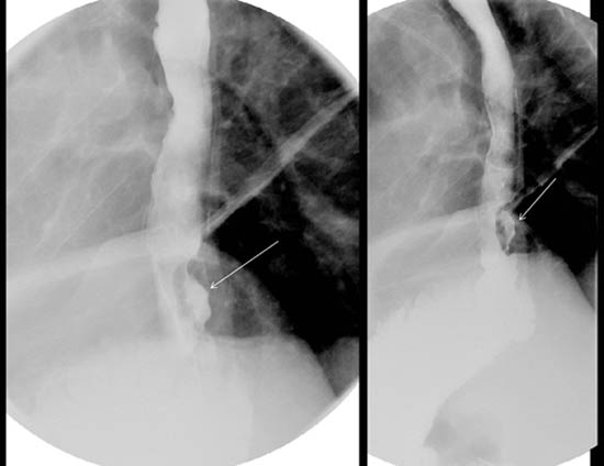 Rayos-x del tracto gastrointestinal superior 