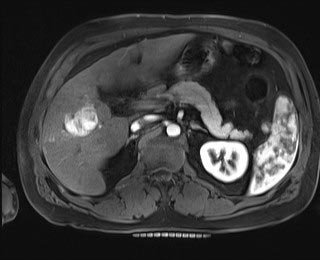MRI scan showing hepatocellular carcinoma