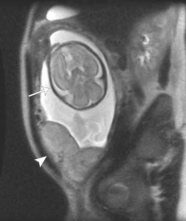 RMN de una mujer embarazada en la que se muestra el cerebro del bebé 