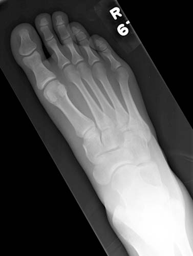  Imagen de rayos X de un pie derecho normal
