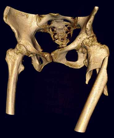 Una imagen de TC en 3D que muestra una fractura conminuta de la cadera