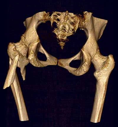A 3D CT image showing a comminuted fracture of the  hip