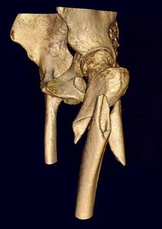 Una imagen de TC en 3D que muestra una fractura conminuta de la cadera