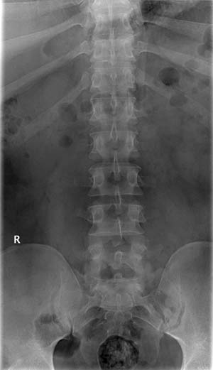 An image showing the normal frontal appearance of the lumbosacral spine