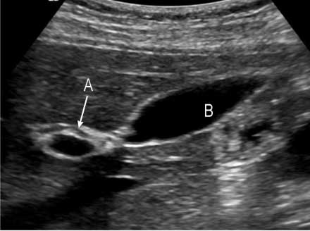 Imagen de ultrasonido de la vesícula biliar y conducto de bilis común