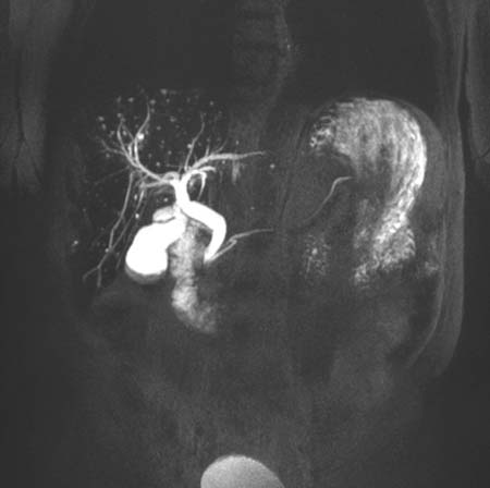 Imagen de MRCP de la vesícula biliar, los conductos biliares y el conducto pancreático