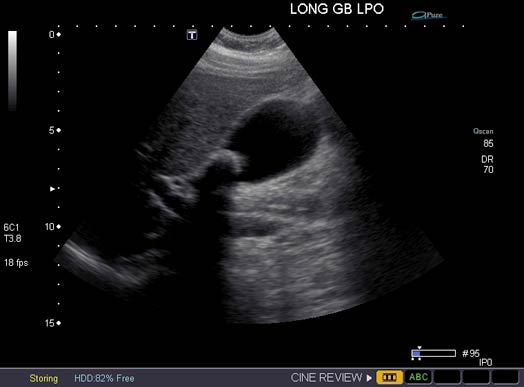 Imagen de ultrasonido que muestra un gran cálculo en la vesícula biliar.