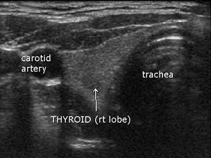 Sonogram of the thyroid