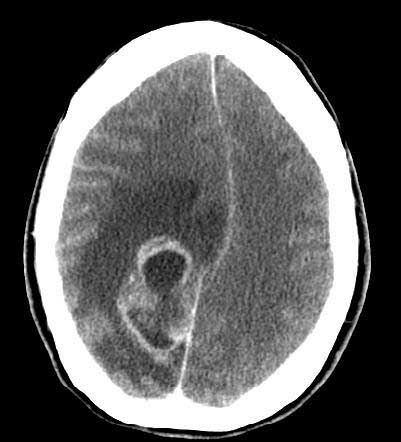 Una tomografía computarizada de la cabeza que muestra un tumor cerebral agresivo
