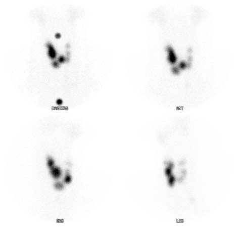 A thyroid scan showing a goiter within the thyroid