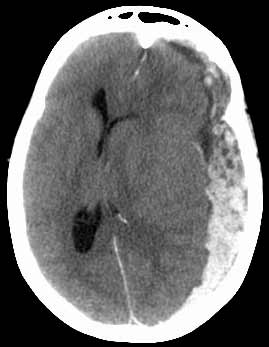Imagen de TC de la cabeza que muestra un hematoma subdural