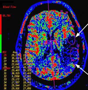 Una imagen de CT de cabeza de perfusión CT