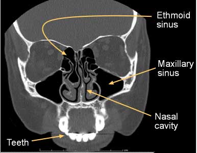 CT scan of the sinuses