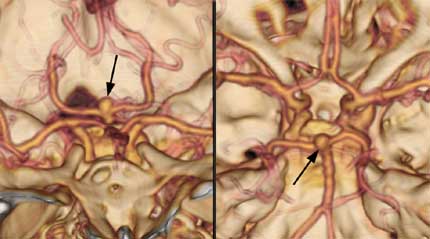 Dos vistas diferentes de una angiografía cerebral por TC