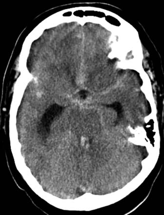 CT image showing a subarachnoid hemorrhage.